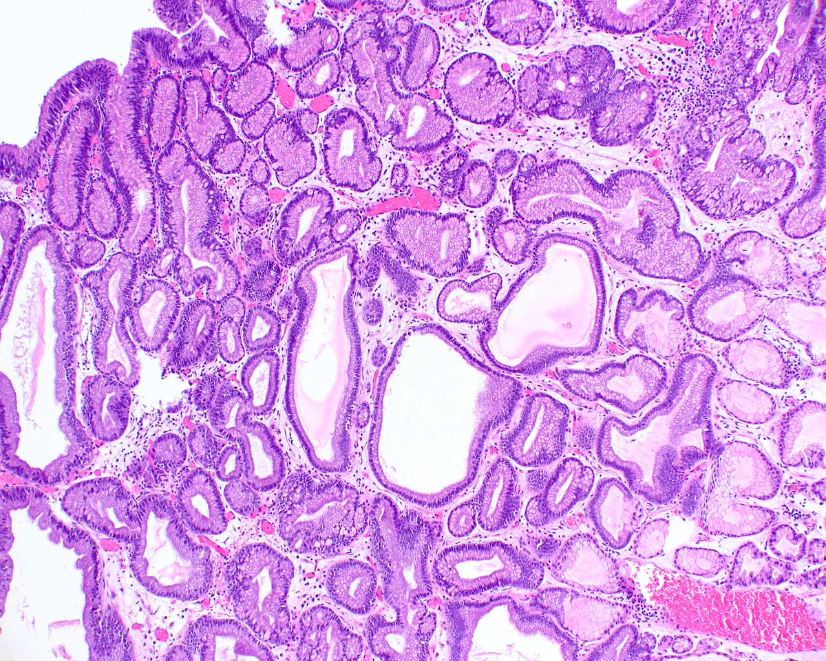 A never-ending obsession with pyloric gland adenomas is a benign problem.  This one arose in otherwise normal gastric oxyntic mucosa and coats the surface!  They are also associated with autoimmune gastritis and probably arise from pseudo-pyloric metaplasia in that setting.
