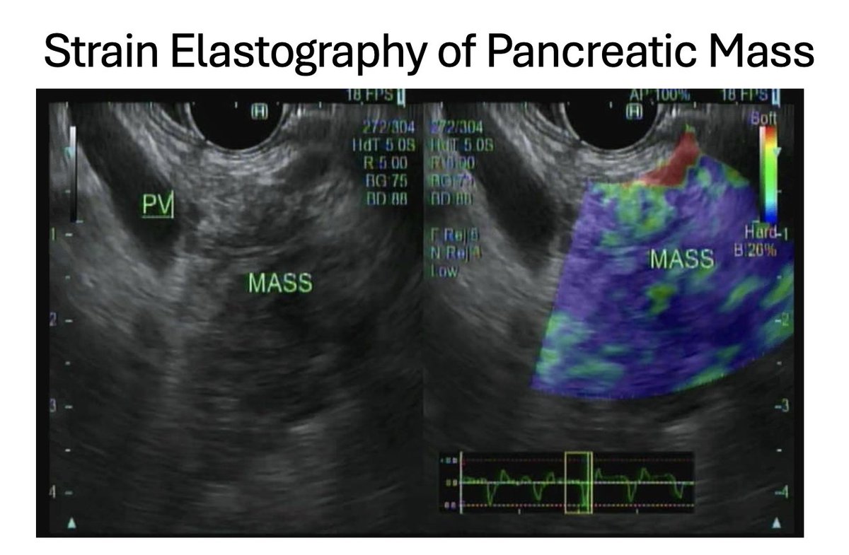 EUSandEndoscopy's tweet photo. Though many #endosonographers do not utilize #elastography during #EUS or may question its clinical usefulness, strain elastography is easy, quick and may help distinguish borders of masses or lymph nodes, areas of highest yield for biopsies by FNB where blue "stiff" or "hard" non necrotic neoplastic tissue is identified.
