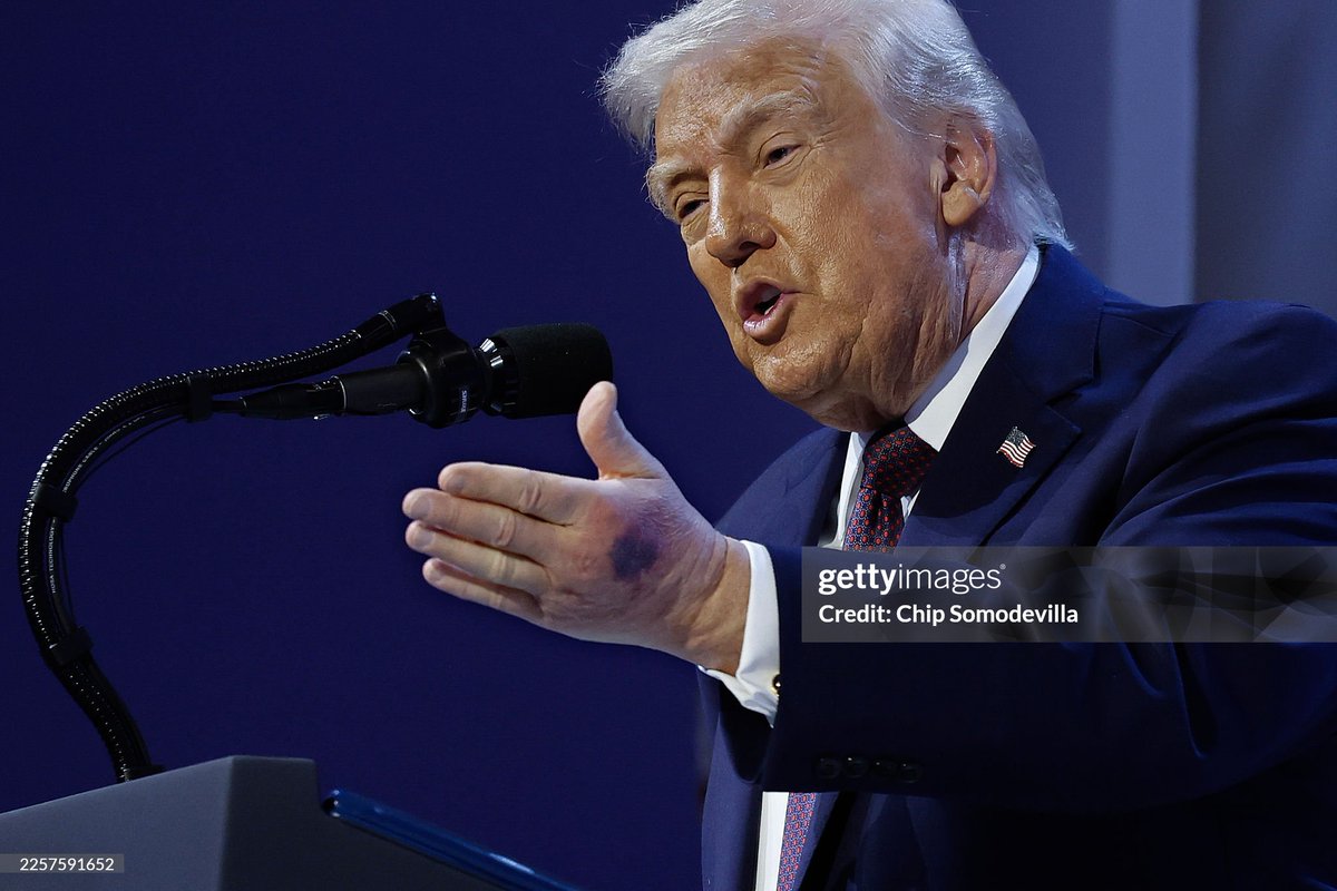 dexter_doggie's tweet image. Trump's left hand has bad bruising now too, and the hand looks puffy. The right hand still has makeup on it. #TrumpHealth