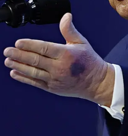 dexter_doggie's tweet image. Trump's left hand has bad bruising now too, and the hand looks puffy. The right hand still has makeup on it. #TrumpHealth
