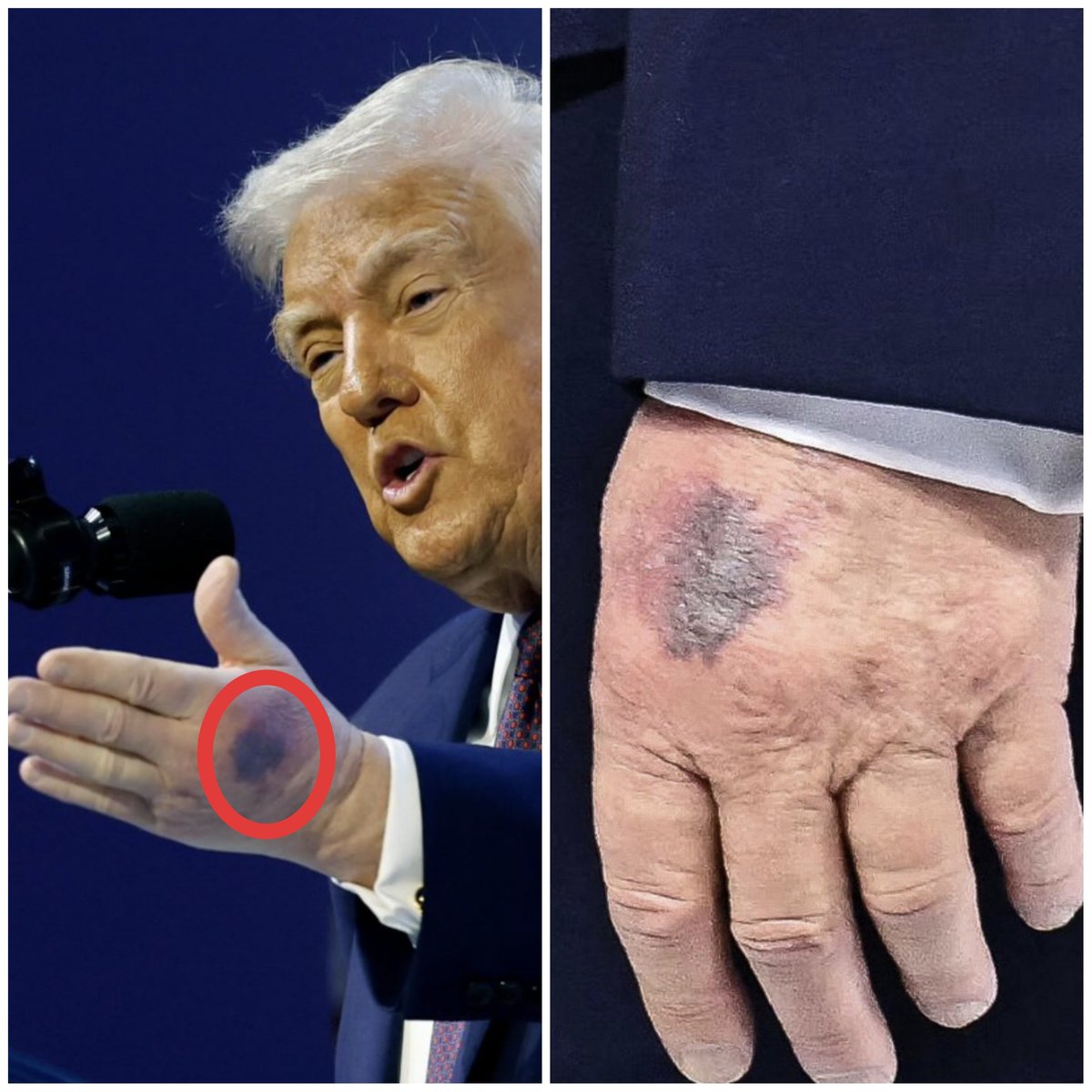 ranvijaylive's tweet image. Hello @grok, why is Trump's hand bruised?
