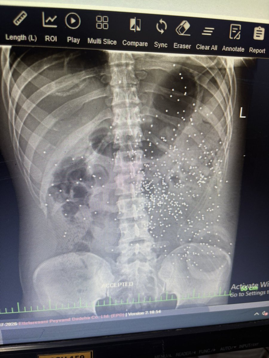 فقط تعداد ساچمه هایی که تونستند به یه نفر بزنند رو ببینید ….
#R2PforIran 
#IranMassacare