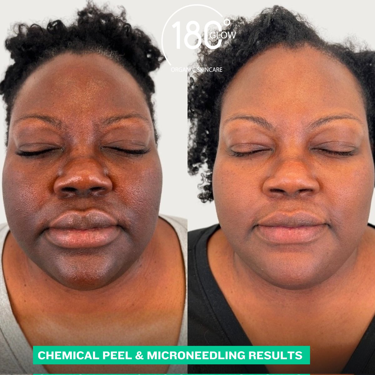 180degreesGlow's tweet photo. Consultations &amp; Deliveries: 0775398372 | 0703398372 
Shop Location: Ntinda-Kiwatule Road opposite Eliana Hotel. Also on Google Maps 

#skin #Uganda #organic #plantmade #glow #180degreesglow https://t.co/l0BoVcxNMY