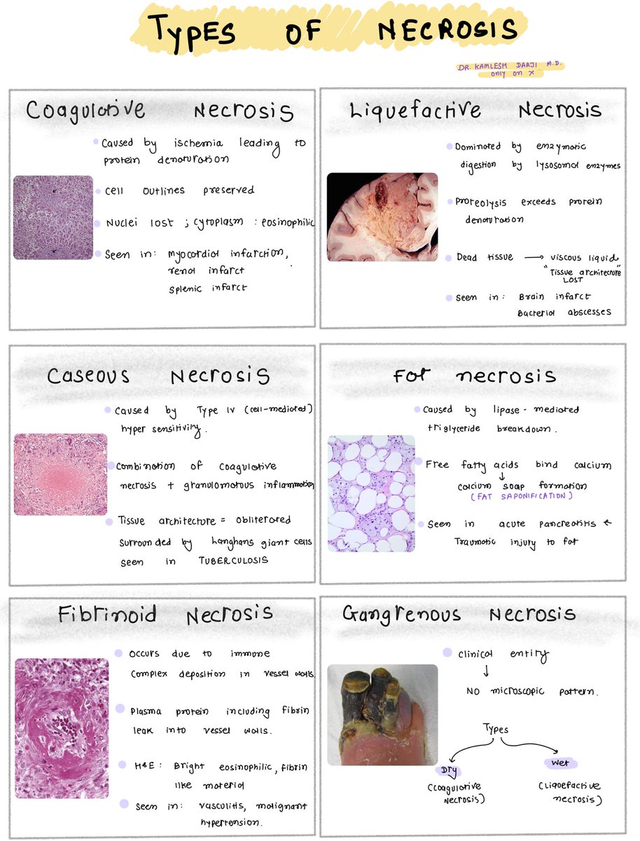 DrKamleshDarji1's tweet image. Types of necrosis #MedTwitter #PathX