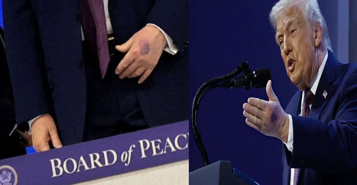 onlineindus's tweet image. Trump Shrugs Off Health Concerns After New Hand Bruises Appear
#DonaldTrump #TrumpHealth #handbruise #BoardOfPeace #WEF2026 #USPolitics #CardiovascularHealth #speculation #onlineindusnews onlineindus.com/english/trump-…
