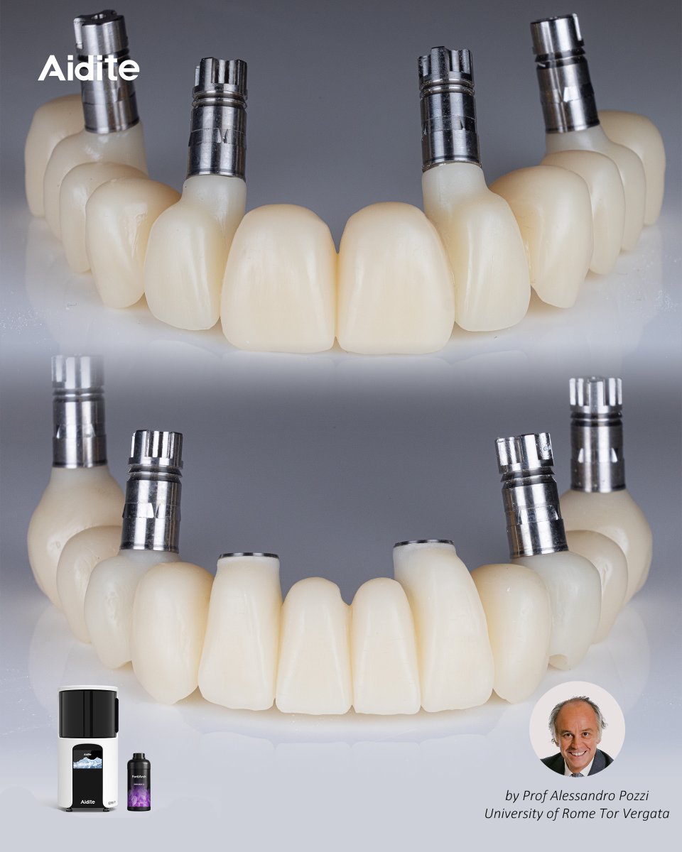 AiditeLtd's tweet image. 🦷 All-On-X Immediate Loading
Prof. Alessandro Pozzi | University of Rome Tor Vergata
Powered by FortiArch Crown &amp;amp; Bridge Resin, featuring 53% ceramic fillers for reliable, immediate restorations.
⚡ DM us to see the full workflow!
#Aidite #FortiArch #ImmediateLoading