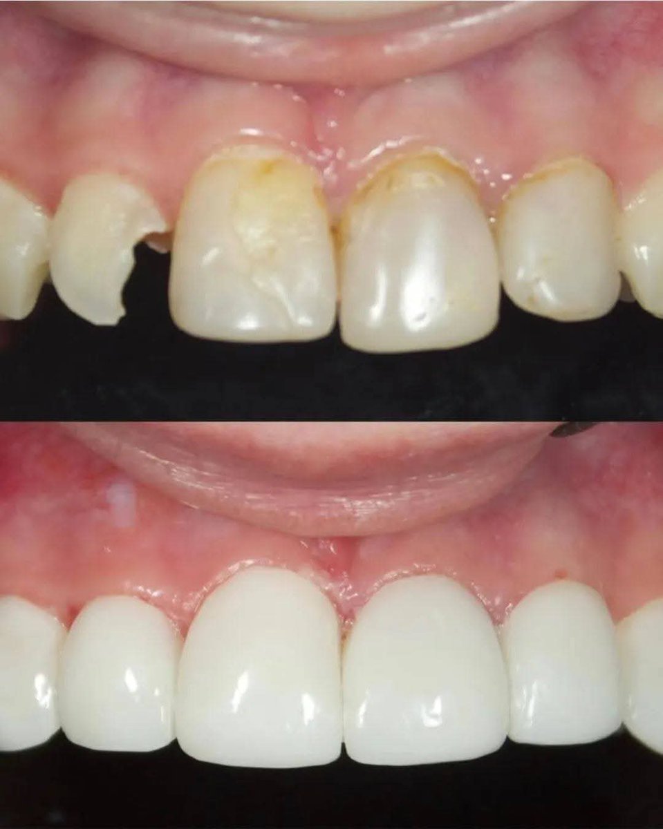 ogretmensitemiz's tweet image. Sivas’ta Devrim Yapan Hoca Hedefte: Çekmeden Kurtardığı Dişler Rahatsız Etti
Sivas Cumhuriyet Üniversitesi Diş Hekimliği Fakültesi Öğretim Üyesi Prof. Dr. İhsan Hubbezoğlu, diş hekimliğinde ezber bozan bir yöntemle implantı son çare olmaktan çıkarıyor.
Sağlam diş köklerini Cam…