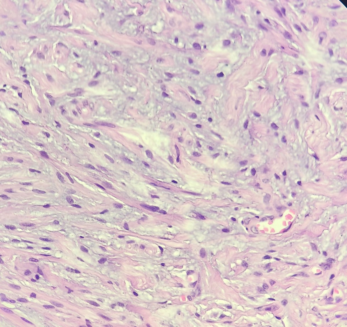 Vasant panchami special 🌸🌼
Elderly male scalp lump

#pathtwitter #headandneckpath #dermpath