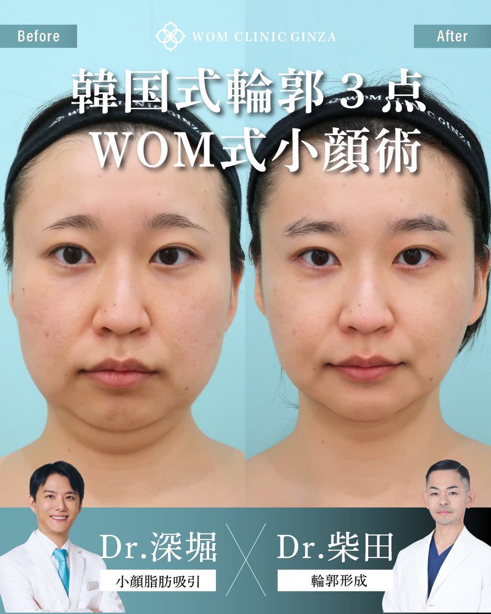 『顎下ペラペラ脂肪吸引』小顔整形専門Dr 深堀 tweet media