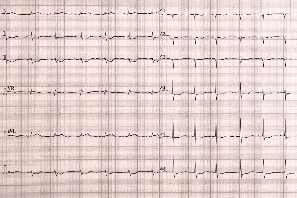 A 55-year-old man, known case of hypertension and dyslipidemia on treatment, presents to the ER with acute onset severe retrosternal chest pain for 2 hours, radiating to the jaw and both shoulders, associated with dyspnea, palpitations, nausea, and profuse diaphoresis. Pain is