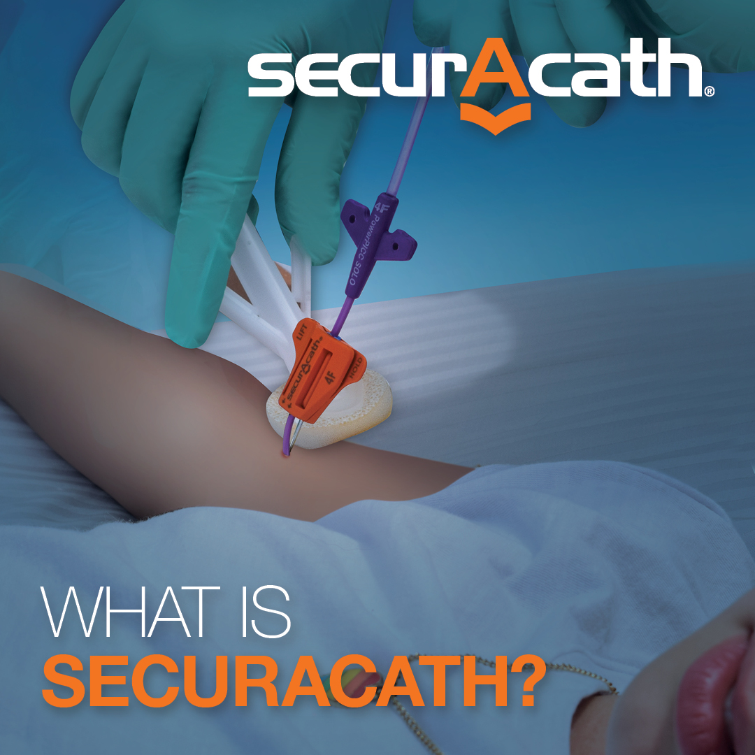 SecurAcath's tweet photo. What is SecurAcath? A subcutaneous catheter securement system that uses small flexible feet beneath the skin to hold lines in place, w/o sutures or adhesives. Results: easier dressing changes, improved comfort + securement #ForTheLifeOfTheLine. More: https://t.co/taqPGdy4Pw https://t.co/D5S2Hj47Fq