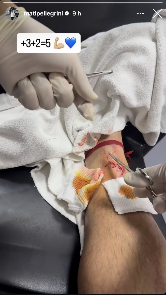 Para Andres Merlos, esta jugada ni siquiera fue falta. Para el VAR no fue una patada de expulsión, ni llamaron para que lo revise. A Matias Pellegrini lo tuvieron que coser con 2 puntos.

En Ezeiza estaba Jose Carreras, que volvía a dirigir tras ser VAR en el escandaloso robo de