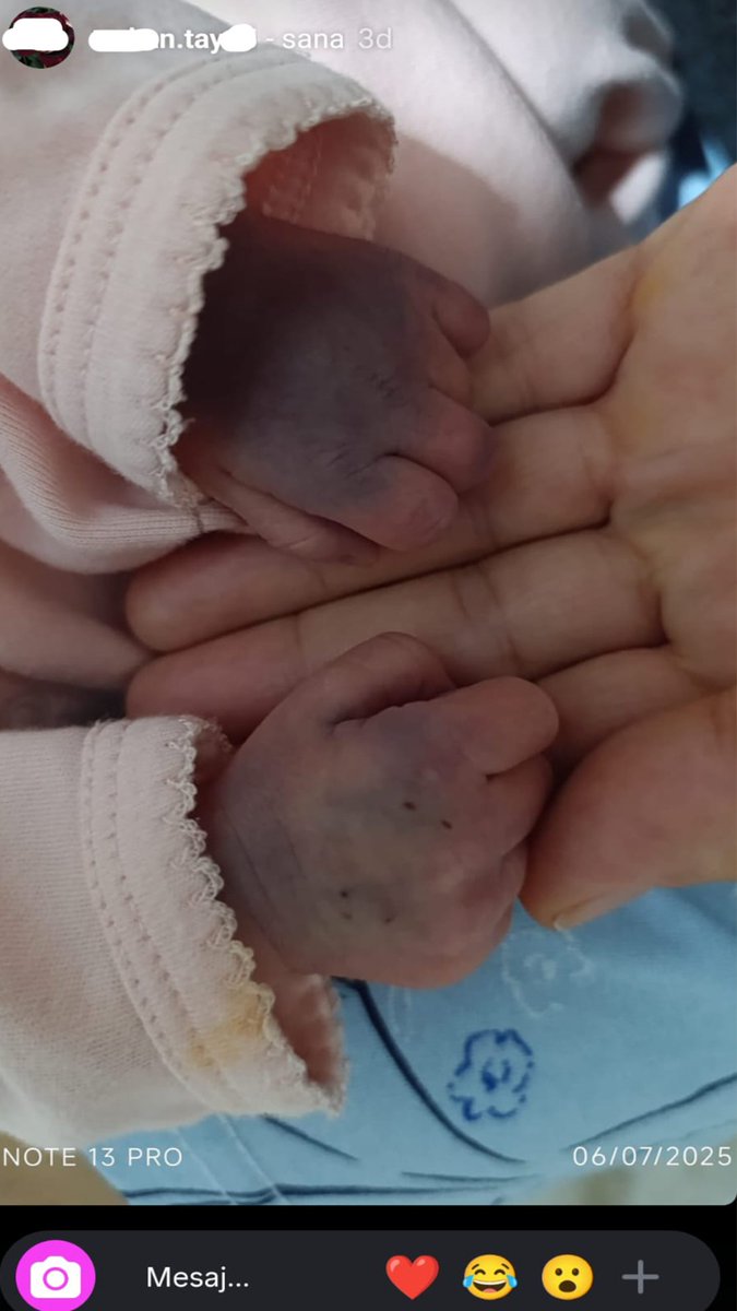 Murat51761's tweet photo. Yeni Doğanda Skandal Bitmiyor: Bebeğin Elleri Böyle Görüntülendi
3 Temmuz’da dünyaya gelen yeni doğan bebek, yalnızca iki gün yoğun bakımda kaldı.
Anne, bebeğini ziyaret ettiğinde ellerindeki durumu fark edince endişelendi.👇👇👇
https://t.co/50sTwkJFlO https://t.co/Kj1GlUcbqo