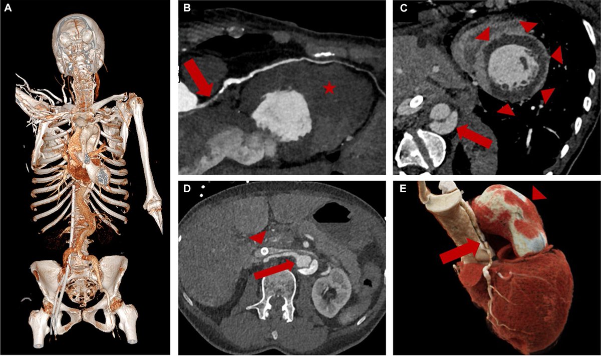 New in JACEP Open: Extracorporeal Cardiopulmonary Resuscitation for Cardiac Arrest and Myocardial Infarction: A Diagnosis Beyond the Obvious

A 66-year-old woman with anterior STEMI arrested and underwent ECPR after initial TTE showed no reversible cause; later imaging revealed