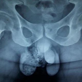 docakx's tweet photo. Gas inside scrotum.

What is this? https://t.co/NhZ0pKbdbN