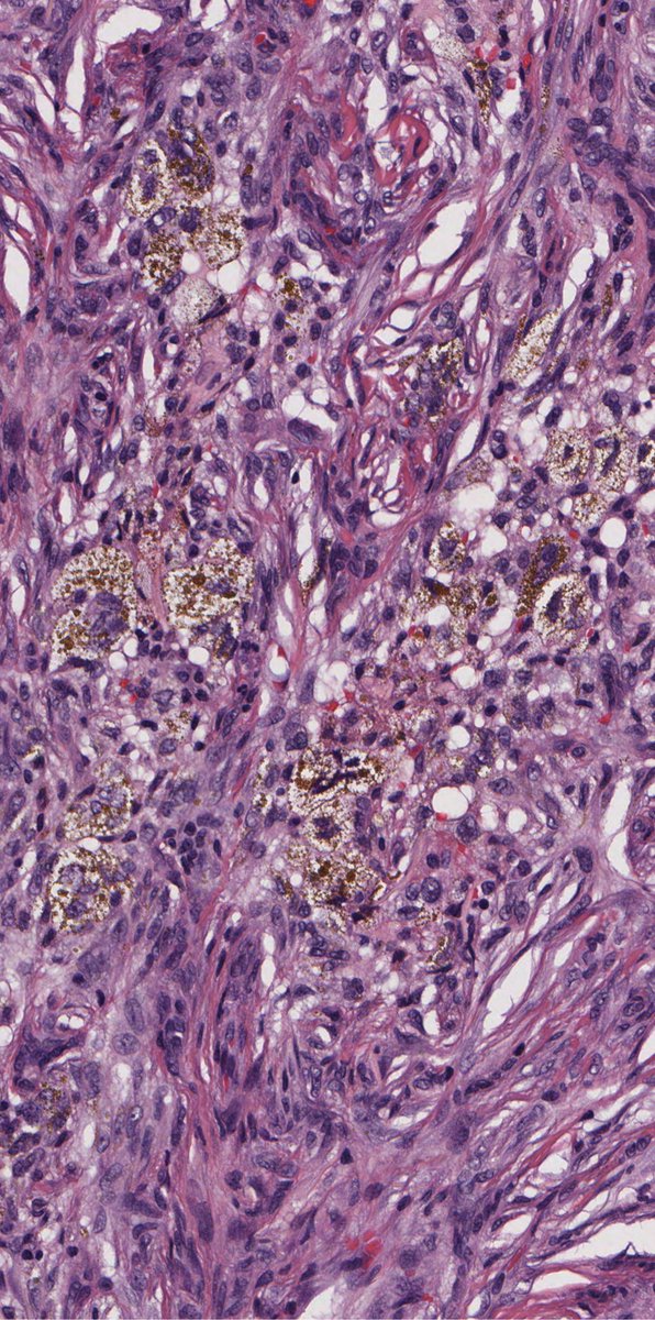 DrCycloPath's tweet photo. #TooCloseToDiagnose? 🧐
A. Dermatofibrosarcoma protuberans
B. Dermatomyofibroma
C. Hypertrophic scar
D. Dermatofibroma
#Pathology #Dermatology #Dermatopathology #DermPath https://t.co/0qEV9cXIpx