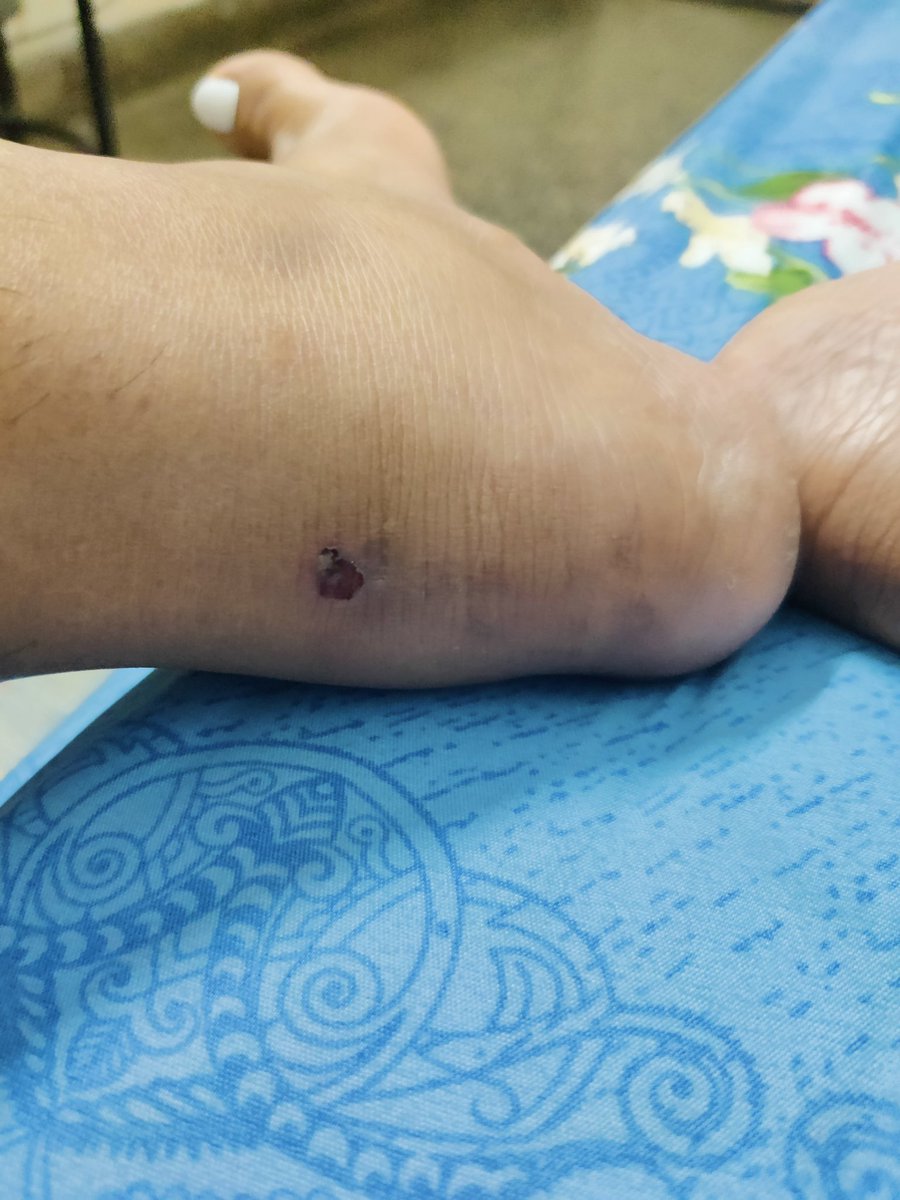 khera_divya's tweet photo. @Flipkart @flipkartsupport 
Dear Flipkart I bought a @PUMA shoes from you, in July 25 never wore it, just started wearing it for my walk and on the second wear I got super serious shoe bite.
Which I don't consider to be normal from a brand like @PUMA 
Tell me what can be done. https://t.co/hnKii55U69