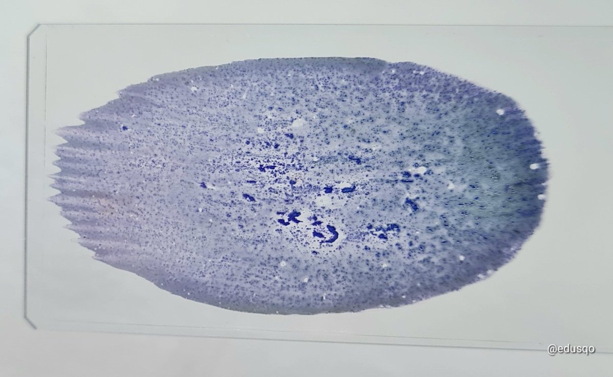 edusqo's tweet image. It only took 6 seconds. 25G. No anesthesia, almost imperceptible to the patient, on-site assessment 🔬, and certainty of a sufficient sample, in both quality and quantity. What more could you ask for?
#FNAFriday #CytoPath #EndoPath