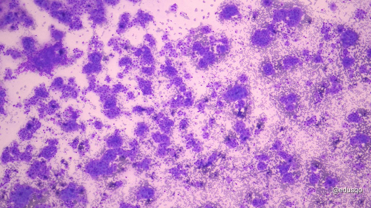 edusqo's tweet image. It only took 6 seconds. 25G. No anesthesia, almost imperceptible to the patient, on-site assessment 🔬, and certainty of a sufficient sample, in both quality and quantity. What more could you ask for?
#FNAFriday #CytoPath #EndoPath
