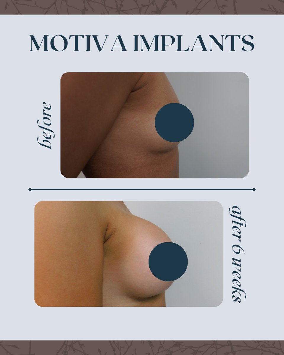 bellissimops's tweet photo. This transformation highlights what is possible with advanced breast implant technology. Motiva Implants are designed with a bonded gel and shell structure that supports a softer feel, balanced projection, and long-term stability. ✨ https://t.co/azh9gMihrb