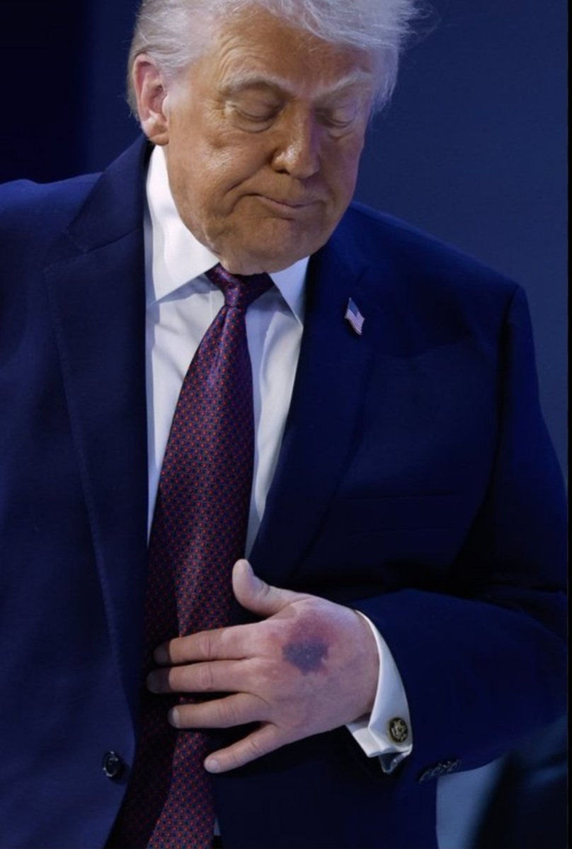 PILNE❗❗
Tajemnica plamy na dłoni Trumpa wyjaśniona.