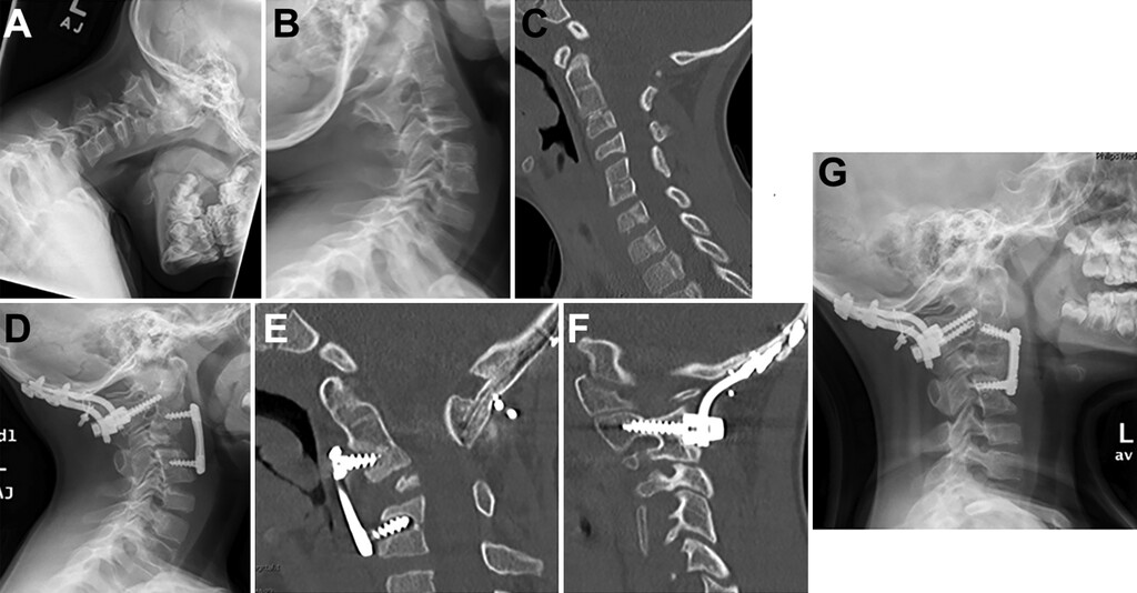 TheJNS's tweet photo. #OnlineFirst: The anterior cervical approach in pediatric patients: indications and outcomes

https://t.co/xUIcoHXAAo https://t.co/1GHIwHal0d
