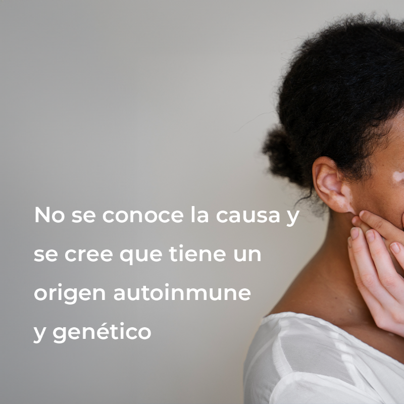 hospitalangeles's tweet photo. Se estima que el vitiligo afecta entre 1 y 2% de la población mundial y es posible que aparezca en cualquier etapa de la vida. Síguenos para conocer más sobre el vitiligo y el cuidado de tu salud en general.