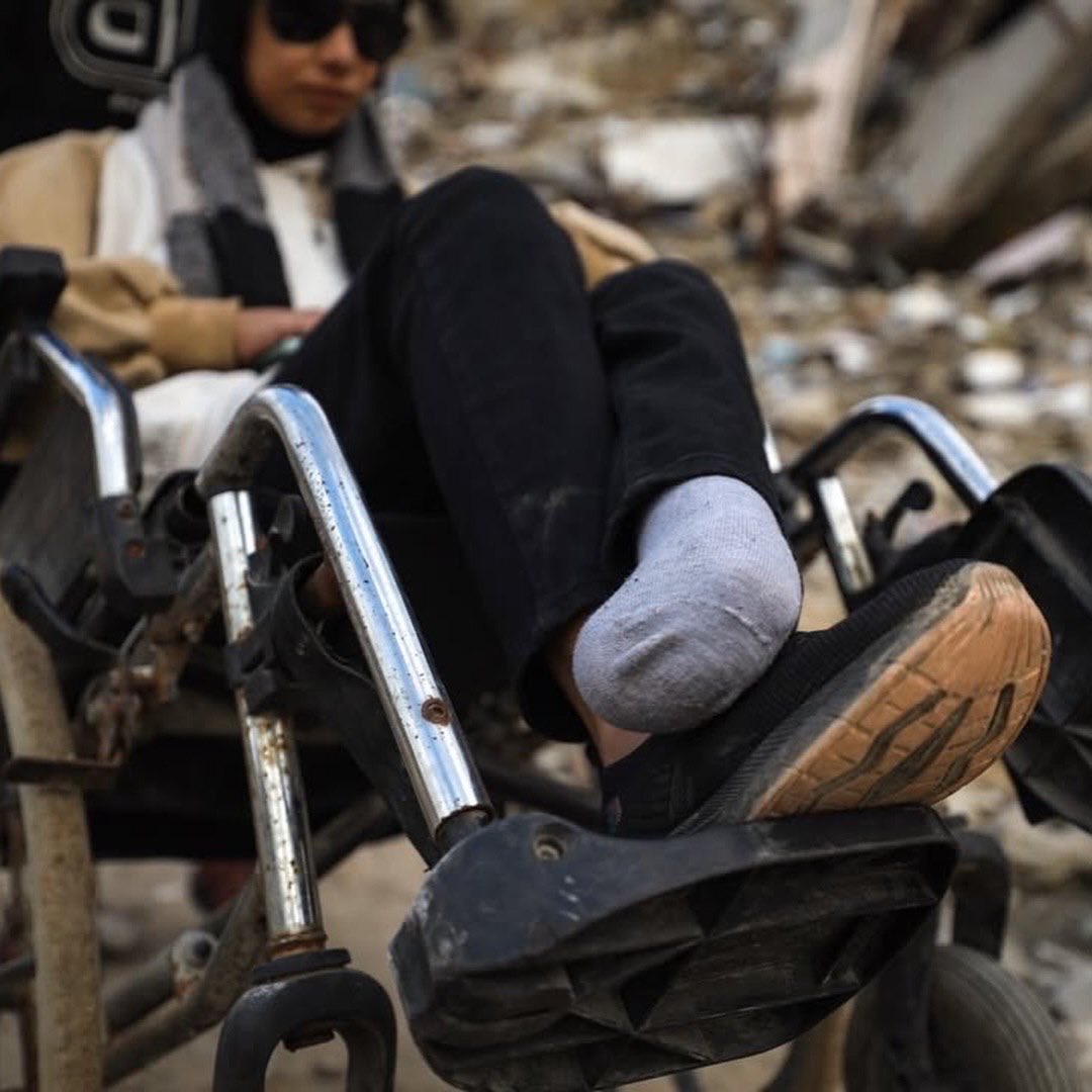 17-year-old Farah Mahmoud al-Kahlud, who lost a leg and an eye in an Israeli attack on her home in Jabalia, shows the eye she lost in Gaza City, Gaza on January 19, 2026. In the same attack, Farah lost her parents, and she also completely lost one eye.
