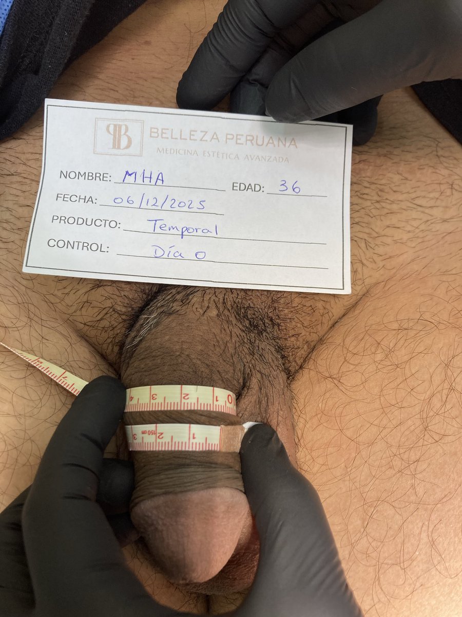 Dra__Fit's tweet photo. Hola mis Pepitos! Viernes de mostrarles otro caso que llegó con una medida de 9.8cm y después de 1 mes y 15 días la medida aumentó 3.2cm a 13cm de circunferencia.

Si tú también quieres tener estos resultados, escríbeme para agendar tu cita🍆🔥 https://t.co/uyX8ps0PRC