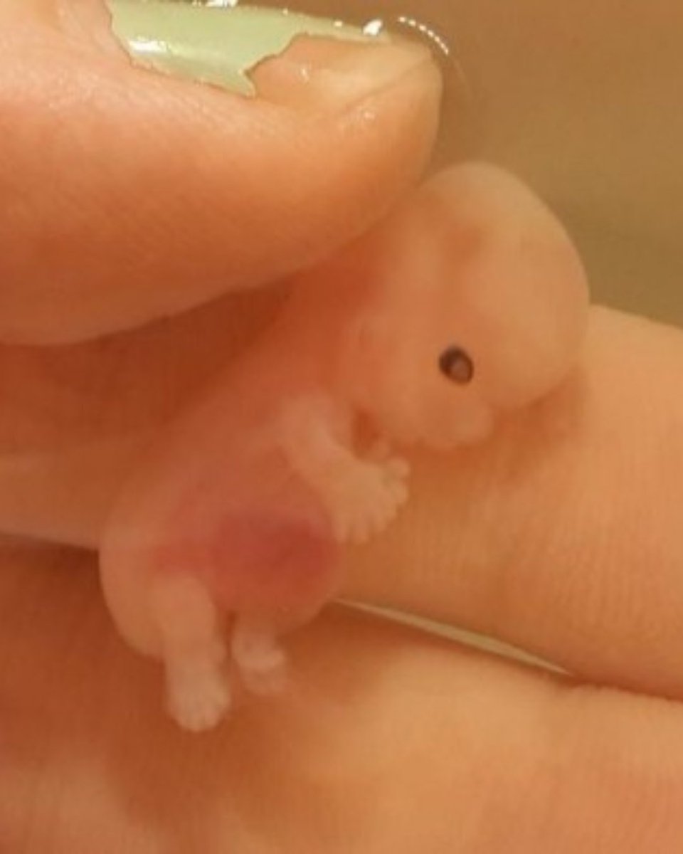 This is what a baby looks like at 8 weeks.

The vast majority of abortions occur in the 1st trimester, when many babies look just like Annabelle.

Annabelle and her twin sister Riley were sadly miscarried, yet their humanity lives on through their mother Mindy’s desire for the