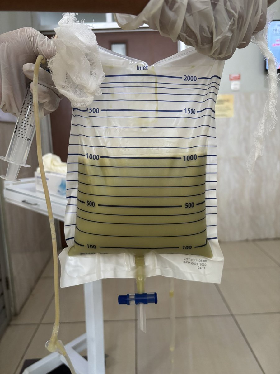 ADITYAALFARIZI's tweet image. Kemarin pungsi pleura atau menyedot carian paru 5 pasien dalam satu hari. Varian rasanya, maksudnya warna cairan cukup beragam.

Warnanya mirip matcha, jeruk nipis, coklat, dan americano.

Oiyaa, btw kebetulan banget pasiennya ibu-ibu semua

Tebak kebiasaan suami?