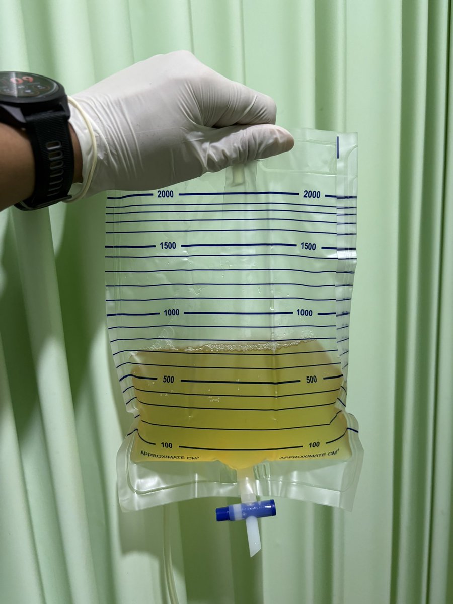 ADITYAALFARIZI's tweet image. Kemarin pungsi pleura atau menyedot carian paru 5 pasien dalam satu hari. Varian rasanya, maksudnya warna cairan cukup beragam.

Warnanya mirip matcha, jeruk nipis, coklat, dan americano.

Oiyaa, btw kebetulan banget pasiennya ibu-ibu semua

Tebak kebiasaan suami?