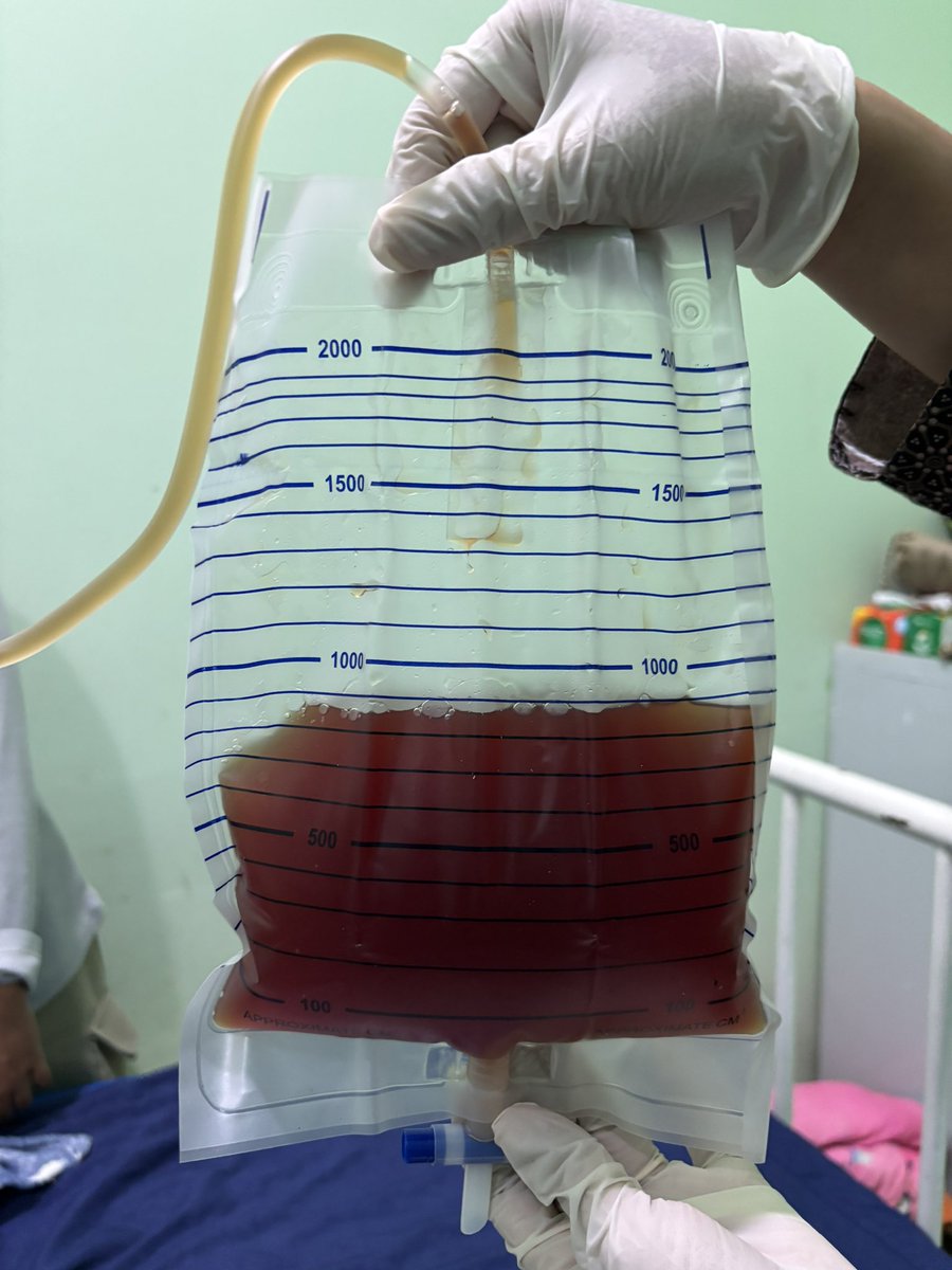 ADITYAALFARIZI's tweet image. Kemarin pungsi pleura atau menyedot carian paru 5 pasien dalam satu hari. Varian rasanya, maksudnya warna cairan cukup beragam.

Warnanya mirip matcha, jeruk nipis, coklat, dan americano.

Oiyaa, btw kebetulan banget pasiennya ibu-ibu semua

Tebak kebiasaan suami?