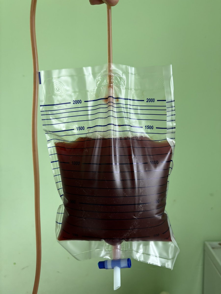 ADITYAALFARIZI's tweet image. Kemarin pungsi pleura atau menyedot carian paru 5 pasien dalam satu hari. Varian rasanya, maksudnya warna cairan cukup beragam.

Warnanya mirip matcha, jeruk nipis, coklat, dan americano.

Oiyaa, btw kebetulan banget pasiennya ibu-ibu semua

Tebak kebiasaan suami?