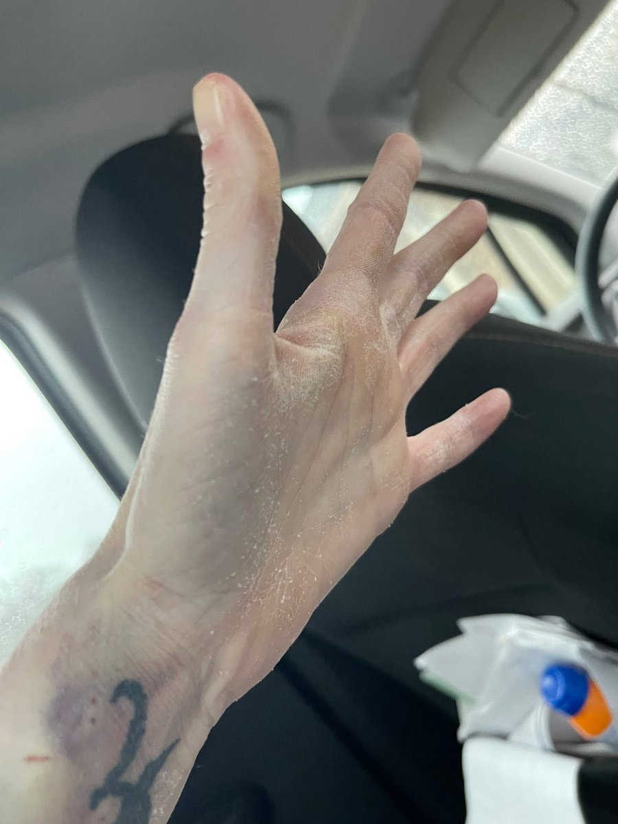 AllTimeJenn's tweet image. When you spend almost a week in the ICU after a stroke and you come home looking and feeling like Gage Creed post semi wreck @MikoHughes #PetSematary