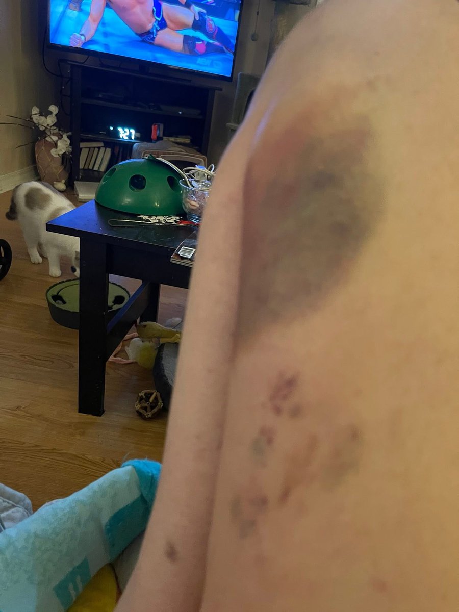 AllTimeJenn's tweet image. When you spend almost a week in the ICU after a stroke and you come home looking and feeling like Gage Creed post semi wreck @MikoHughes #PetSematary