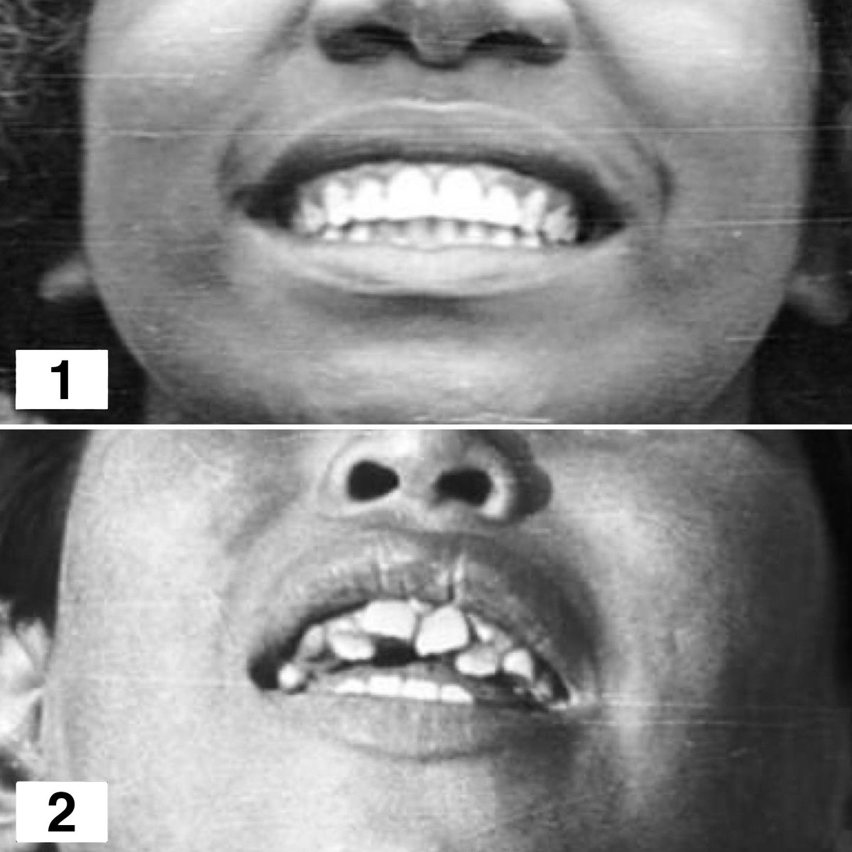 WestonAPrice's tweet image. How the teeth tell the tale! This post is inspired by that of one posted by Mercedes Ramos Vértiz, a dentist in Buenos Aires and is a repeat that we posted in 2023, but think it is worth an encore. It is foundational to what we teach.

The first photo, captured by Dr. Weston A.…
