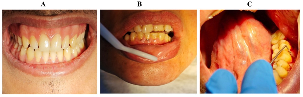 Role of #CD117 and #mastcells in #periodontaldiseases: Histological and immunohistochemical study

doi.org/10.5455/jabet.…