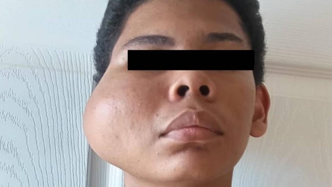maxilolapaz's tweet photo. 🔹La lucha de un adolescente contra un agresivo tumor maxilofacial, vía #Elsiglo

🔸https://t.co/ZDb0FfLhfw   #MAXILOLAPAZ https://t.co/X3iFlc1Hgq