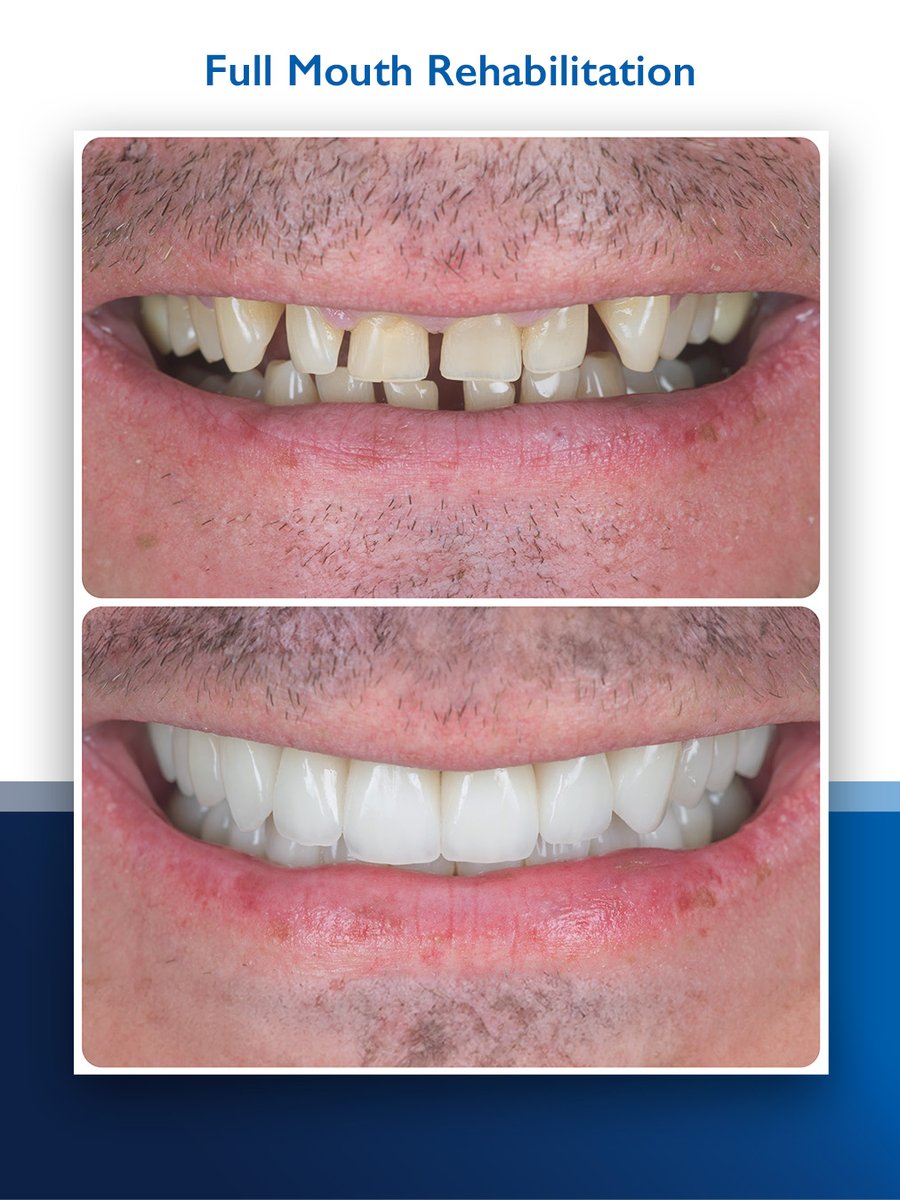With bruxism, which means worn-down teeth, this patient lost all hope for a smile that spoke confidence.

But all this changed for the better, thanks to the expert intervention of our aesthetic and restorative dental specialist, Dr. Khalid Aldabbas.

By placing 26 veneers onto