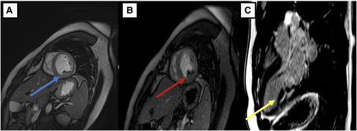 ESC_Journals's tweet photo. Loeffler endocarditis revealed chronic eosinophilic leukaemia 🧬 Rare case of hypereosinophilic syndrome with FIP1L1-PDGFRA rearrangement, intracardiac thrombi and embolic strokes, with remission after chemo + anticoagulation https://t.co/hXCkUxpdaO

#EHJCaseReports @Phiso_de @TJ_Yeo @aayshacader @BoldiKovacsMD @SukritiBanthiya @ANazmiCalik @O_Azizy_MD @saramoscatelli7 @EHJCREiC #CardioX #EPeeps