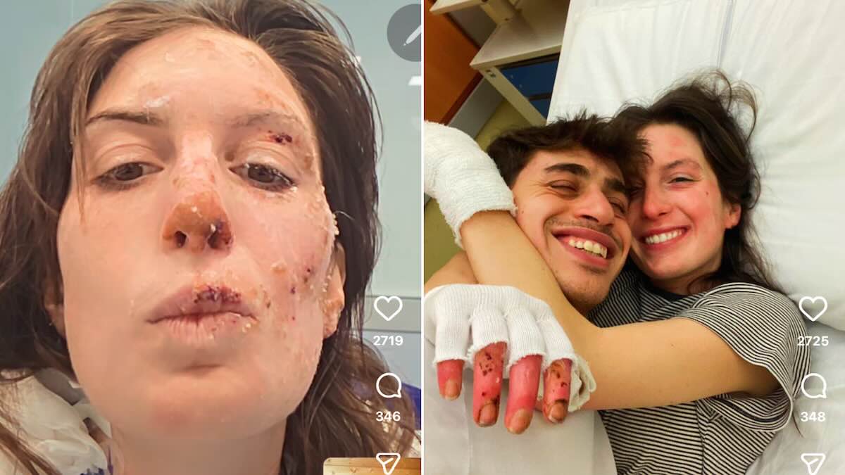 CerfiaFR's tweet photo. 🇮🇹🇨🇭 FLASH | Une survivante italienne de Crans-Montana dévoile son visage brûlé depuis l’hôpital. Eleonora Palmieri doit encore rester en convalescence pour poursuivre les soins liés à ses brûlures et aux séquelles de l’inhalation de fumées toxiques.,Elle a été SAUVÉE par son petit ami, qui l’a sortie des flammes.