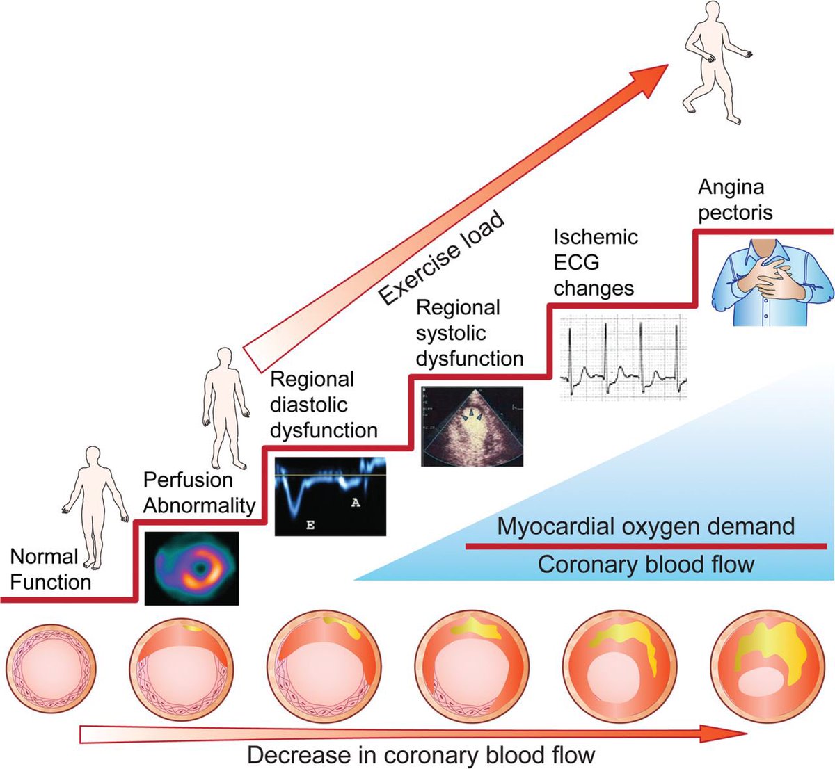 TrackYourHeart's tweet photo. The Ischemic Cascade:
•⬇️perfusion 
•Diastolic dysfunction
•Systolic dysfunction
•ECG changes
•Angina https://t.co/a79sqfOxFv