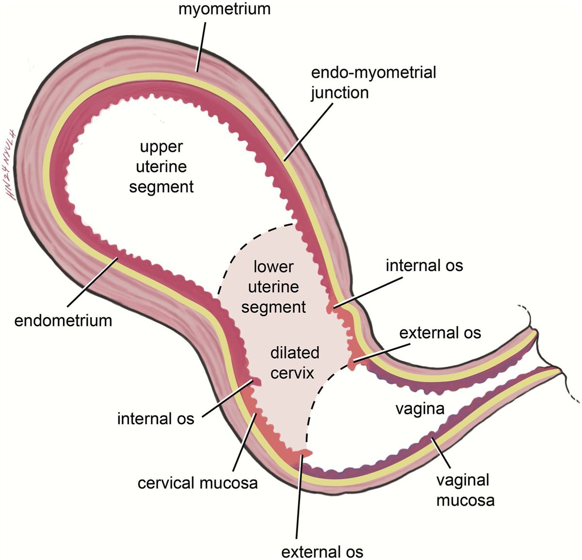 AJOG_thegray's tweet photo. AJOG Expert Review in Cesarean: Endometrium-free closure technique for hysterotomy - Locating the lower uterine segment: The lower uterine segment, where incision should be made to avoid the effaced cervix, is shaded. https://t.co/XBjABGGn5v https://t.co/XCZIjQ402N