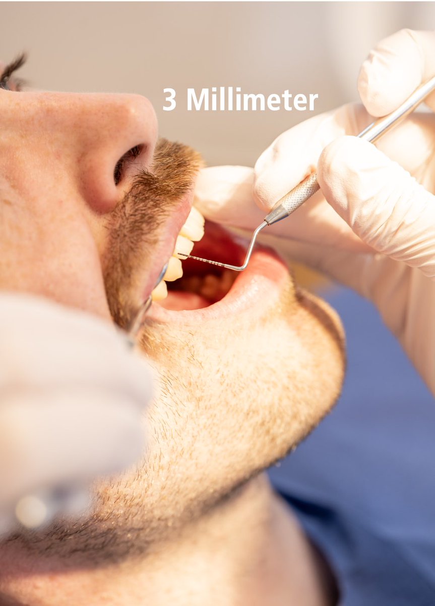 Mit dem Ergebnis kannst du gut leben. Deine Zähne auch. Ist deine Zahnfleischtasche größer als  3,5 mm musst du weiter behandelt werden.
#Parodontitis #PSI #Zahnfleisch #Zahnarzt #kostenlos