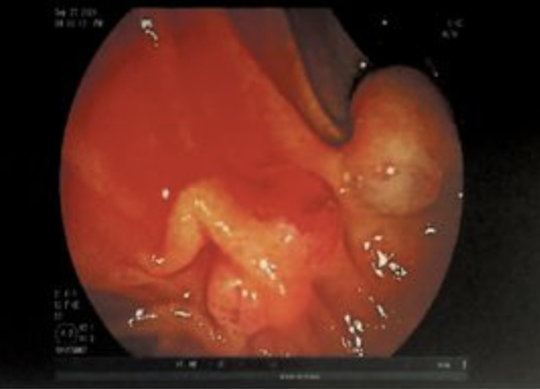 Images_Case's tweet photo. Intraductal Papillary Mucinous Neoplasm Disguised as Pyrosis and Hyperglycemia: A Case Report: Abstract Intraductal papillary mucinous neoplasms (IPMN) are increasing in incidence due to more frequent imaging...https://t.co/zcb38AITOi https://t.co/SsDPPcna4Z