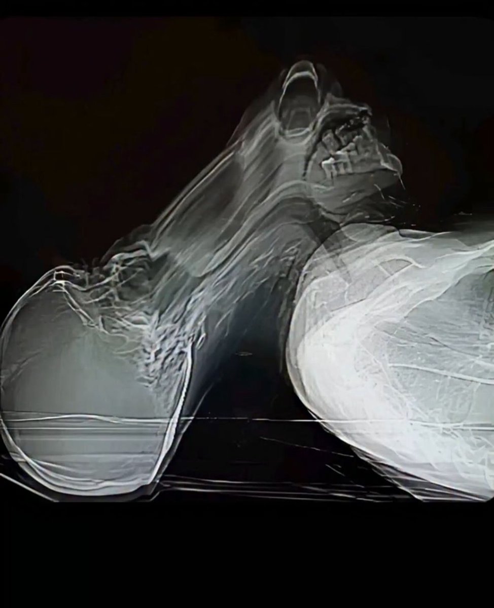 King_Sukunaaa's tweet image. Claustrophobic patient decided to get up during a CT scan