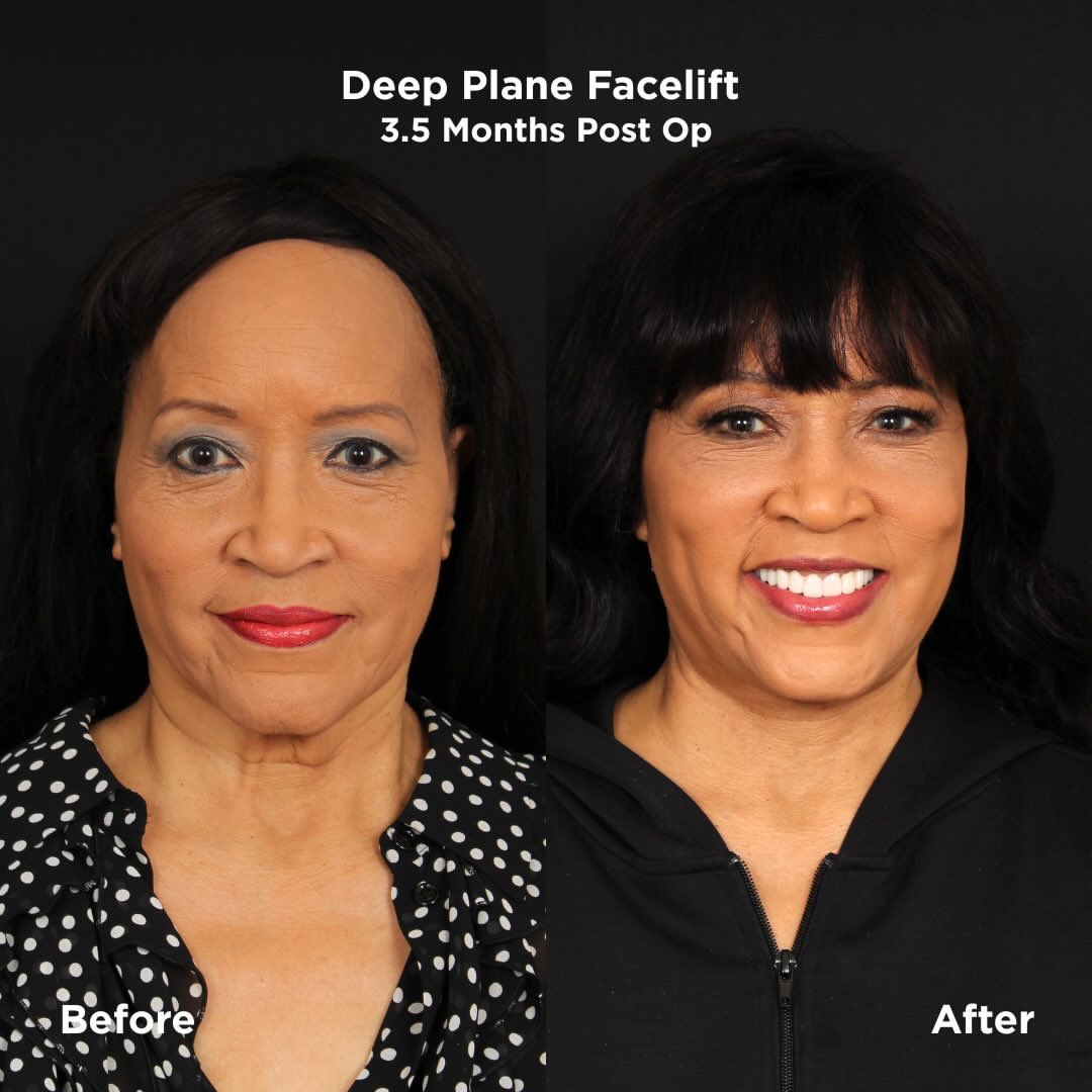 BlockTopickz's tweet image. Jackée shares her facelift results in photos, three and a half months post op

👨‍⚕️Dr. Patrickk Davis: instagram.com/p/DT1UNd5DaYB/…