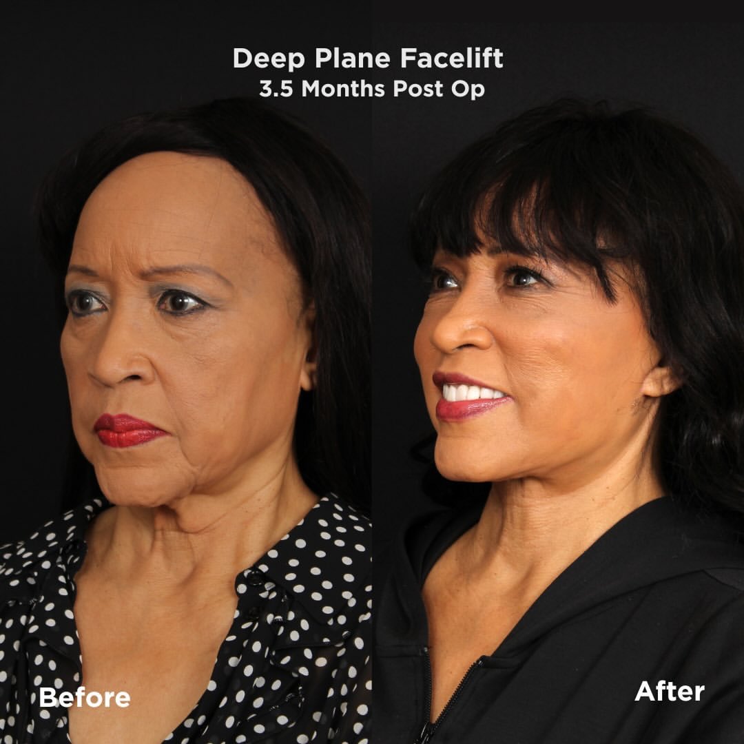 BlockTopickz's tweet image. Jackée shares her facelift results in photos, three and a half months post op

👨‍⚕️Dr. Patrickk Davis: instagram.com/p/DT1UNd5DaYB/…