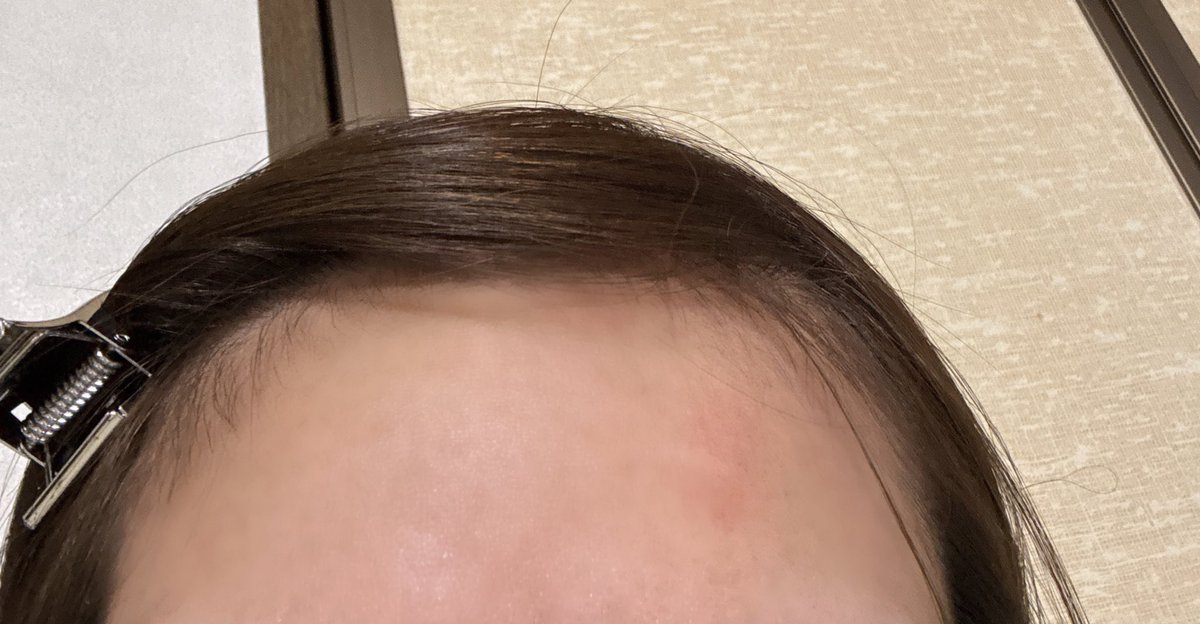 ochibi_minimum's tweet image. 圧倒的になったん不足…😔
おでこのたんこぶすら愛おしい🥰

#南なつ